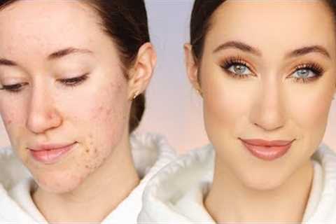 How I Cover My Acne (All Drugstore Makeup) 🙌🏼