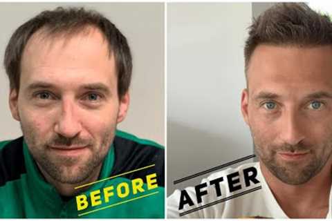 Hair Transplant Growth Timeline | Day 1 To Day 365 Before &amp; After | FirstClass-Esthetic