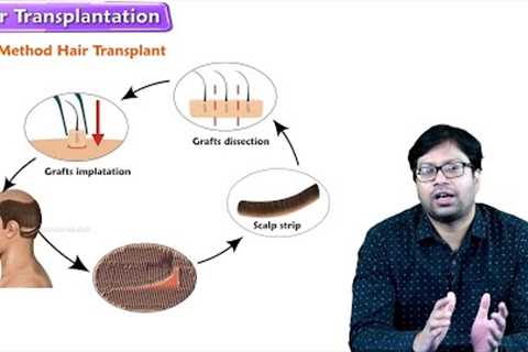 Permanent Hair transplant - Procedure, Types, side effects, before and after results and recovery