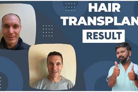 #DrJohnWatts | Should You Worry If You Don’t Notice Hair Growth Two Months After a Hair Transplant?