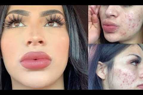 Full-Coverage Acne Makeup-Tutorial!TIPS YOU NEED TO KNOW!