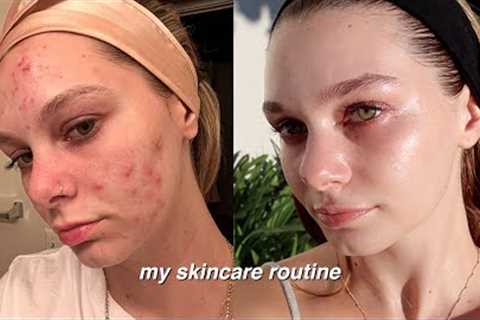 how skin cycling TRANSFORMED my acne prone skin