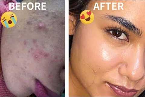 how i got rid of my ACNE on BUDGET| minimal skin care routine