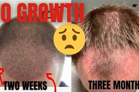 Hair Transplant 3 Months NO GROWTH!