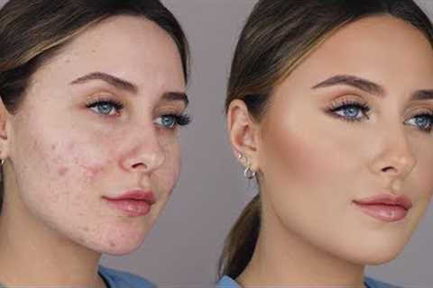 HOW TO COVER ACNE SCARS *easy &amp; non cakey*