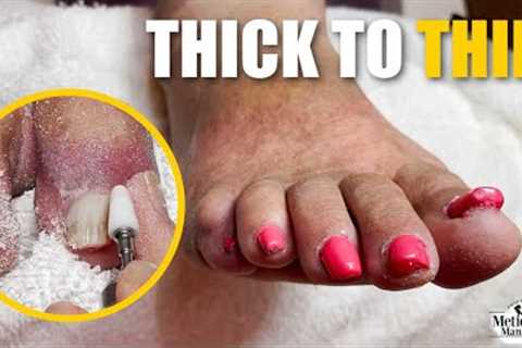👣How to Improve Deformed Toenails👣