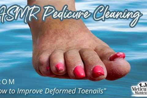 👣ASMR Pedicure Cleaning💆‍♀️How to Improve Deformed Toenails👣