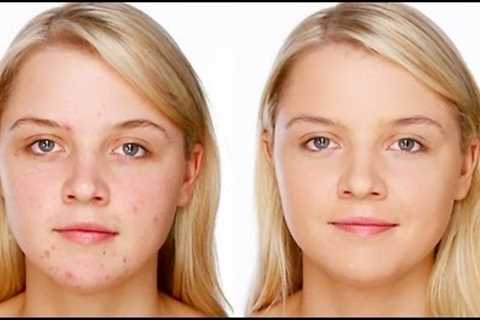 Acne/Blemish Covering Makeup - Foundation &amp; Concealer Tutorial