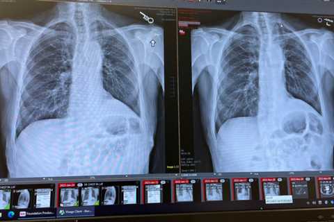 The road to recovery after lung cancer surgery is not without its bumps