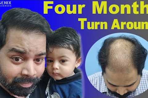 Hair Transplantation Result in 4 Months, @Eugenix by Expert Hair Restoration Surgeons
