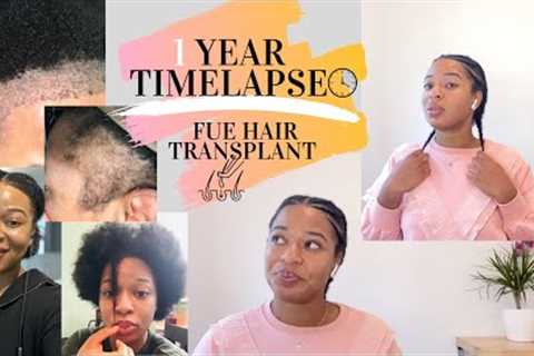 1 Year Time-lapse of my FUE Hair Transplant| Natural Hair