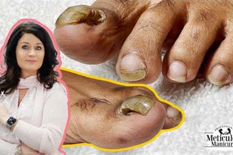 👣Tutorial on How to Care &amp; Treat a Detached Big Toenail with a Pedicure👣