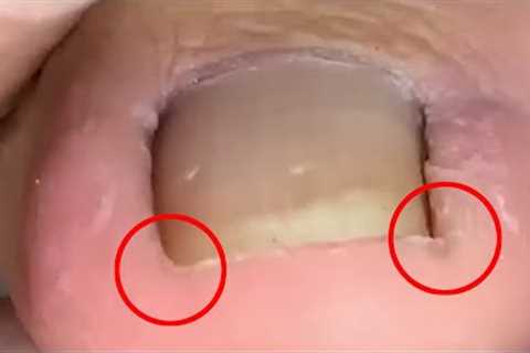 Large ingrown toenails！Satisfying pedicure【Crazy pedicure room】