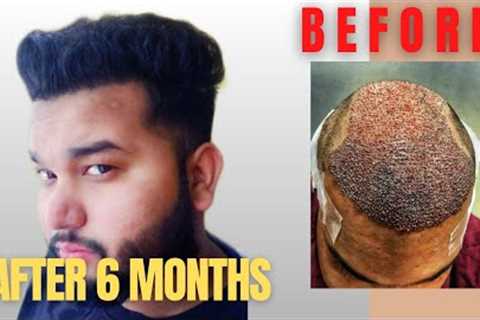 Hair Transplant Journey (SLIDESHOW) | Day 0 to 6 Months | best hair transplant in India 2019
