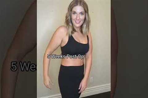 Skin Removal After 100+ Pound Weight Loss