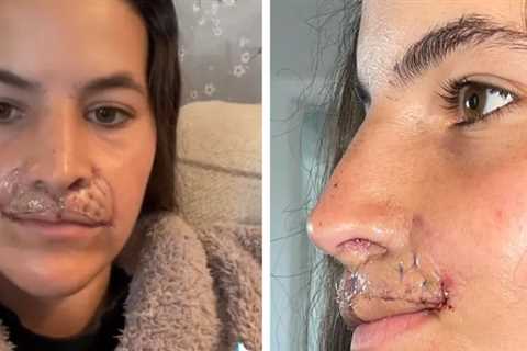 Brooklinn Khoury Shows Off Results of Latest Lip Reconstruction Surgery, Details Procedure