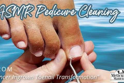 👣ASMR Pedicure Cleaning 💆‍♀️ Pincer Ingrown Toenail Transformation👣