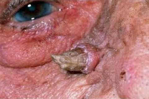 Blackheads &amp; Milia, Big cystic acne blackheads extraction whiteheads Removal Pimple Popping.