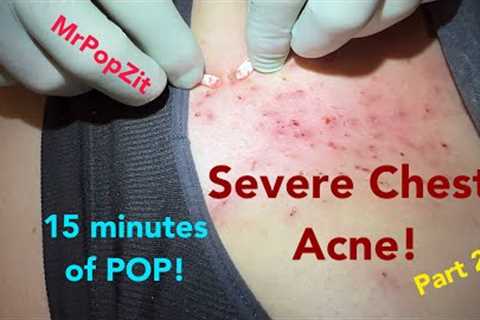 Dozens of clogged pores over the sternum extracted. Blackheads, whiteheads removed.
