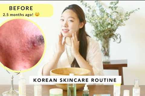 Korean Skincare Routine I ACNE OILY SKIN I HOW TO GET RID OF FUNGAL ACNE,  DARK SPOTS, TEXTURED SKIN