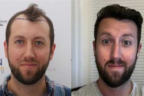 Day 365 - 12 Month Results - Fue Hair Transplant - Updated Hair Loss Prevention Routine