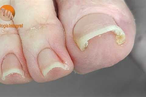 Curved nails [1 year later follow-up]