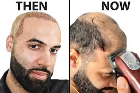 I Shaved My HEAD BALD 4 Years After Hair Transplant | Surgeon Reacts