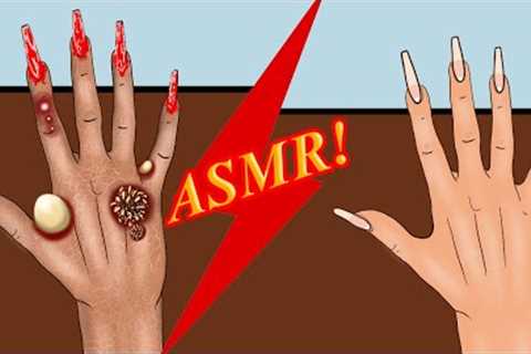Skincare ASMR_ Hand pimples removal and dry skin care , Using hand cream and nail polish remover