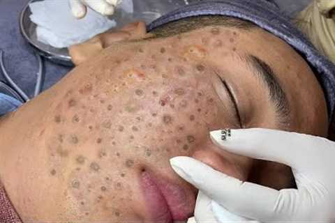 Perfect time every day with Video Popping Tons Of Blackheads