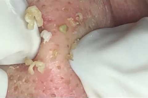 🔥 Pimple Popping 2020 Video| Super blackheads removal in nose| Blackheads extraction| Acne removal