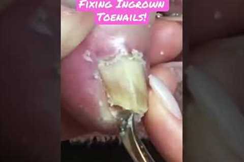 Ingrown toenails can be helped with a pedicure! #ingrown_toenail #pedicure #diypedicure #toenails