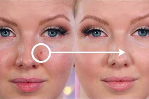 How to Cover and Conceal Acne Blemishes | Makeup Tutorial
