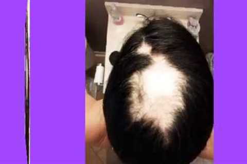 Timelapse of my 2 Year journey with Alopecia. From hair loss to hair growth.