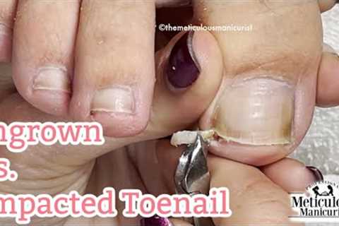 👣Ingrown vs Impacted Toenail (Mr. Meticulous)👣