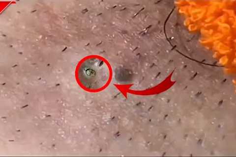 Blackheads Removal | Acne Treatment and Very Satisfying Satisfying Pimple pop  #blackheads