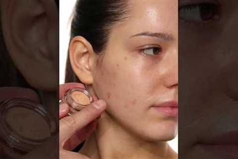 How to cover Acne