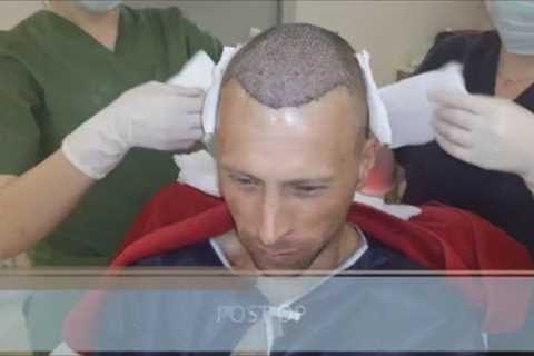 FUE Hair Transplant Growth Timeline - Health Travel International