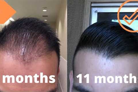 When To Expect Growth After A Hair Transplant *My Timeline