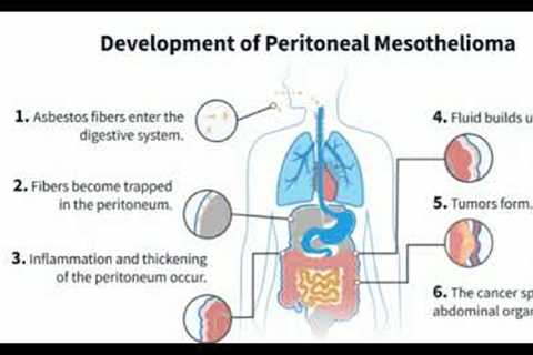 Mesothelioma Attorney | Top Mesothelioma Law Firms | mesothelioma Personal Injury Lawyers