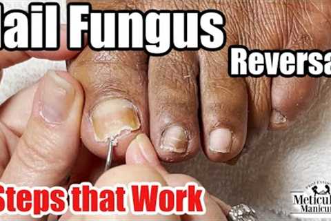A Toenail Fungus Cure! What did she do? 👣