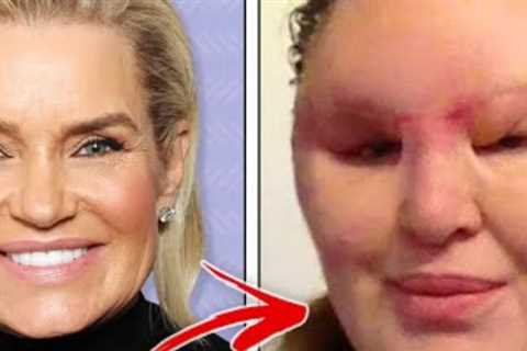 Celebrities who used filler to ruin their faces