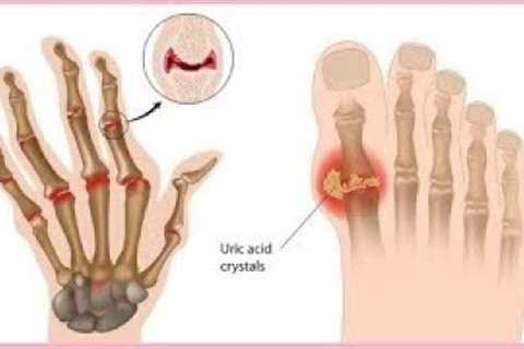 🚨 7 Natural Remedies for Arthritis Pain Relief
