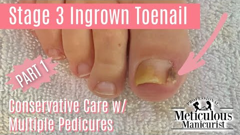 👣How to Pedicure Stage 3 Ingrown Big Toe with Granulation Tissue👣