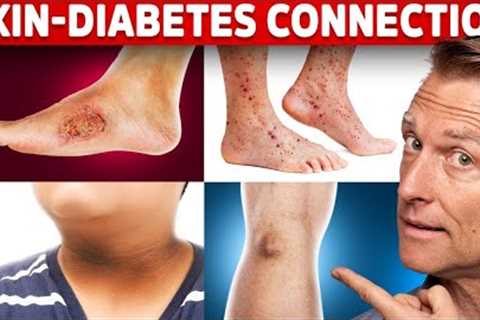 9 Diabetic Skin Problems That Indicate Diabetes
