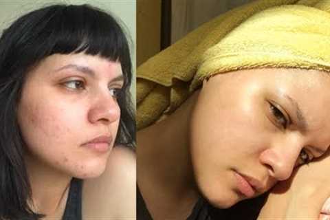Routine that healed my DRY ACNE PRONE skin!!!