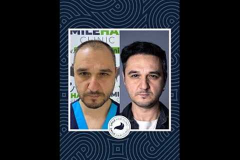 Hair Transplant 1 Year Result - Good decision, True transformation!