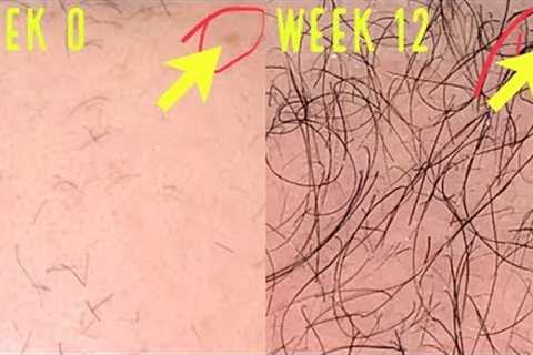 UNBELIEVABLE MICRONEEDLING/DERMA ROLLING RESULTS FOR HAIR GROWTH!