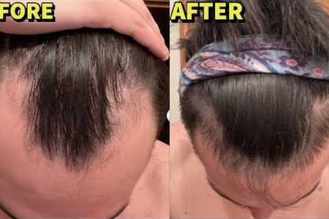 HYPER-RESPONDER ON BIG 3 + MICRONEEDLING HAIR LOSS STACK INSANE 5 MONTH RESULTS!