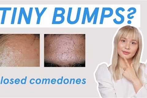 Why those tiny bumps AREN’T fungal acne!