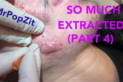 So much extracted! Severe acne before and after. Session 2. Comedones for days